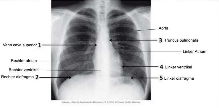 Thorax Xray