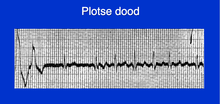 Wat zien we hier als mogelijke veroorzaker van Sudden Cardiovascular Death?