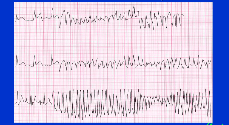 Wat zien we hier als mogelijke veroorzaker van Sudden Cardiovascular Death?