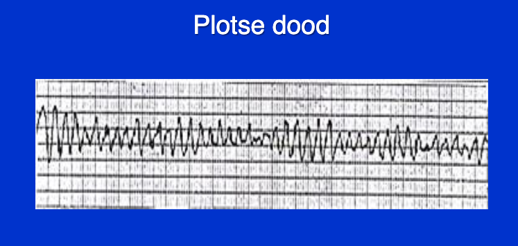 Wat zien we hier als mogelijke veroorzaker van Sudden Cardiovascular Death?