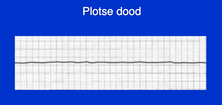 Wat zien we hier als mogelijke veroorzaker van Sudden Cardiovascular Death?