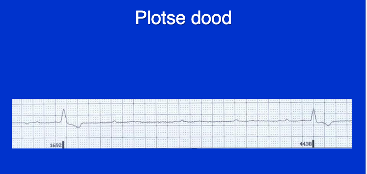 Wat zien we hier als mogelijke veroorzaker van Sudden Cardiovascular Death?