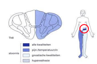 Welk syndroom is dit? Welke uitval kan je hierbij verwachten?