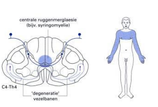 Welk syndroom is dit? Welke uitval kan je hierbij verwachten?