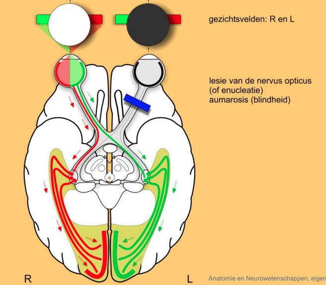 n. Opticus uitval 1