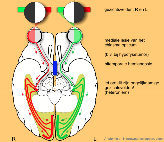 n. Opticus uitval 2