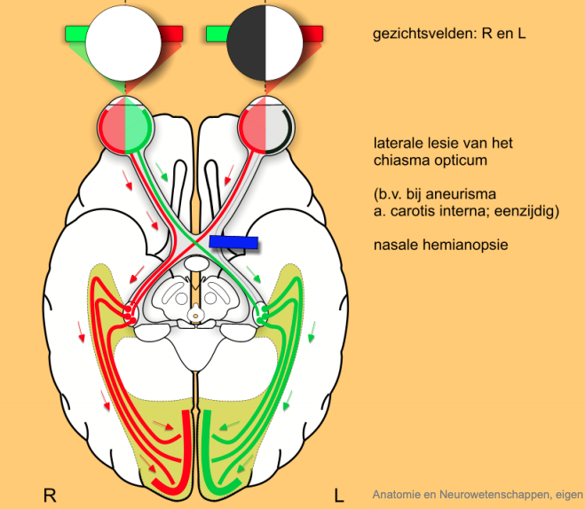 n. Opticus uitval 3