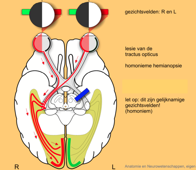 n. Opticus uitval 4