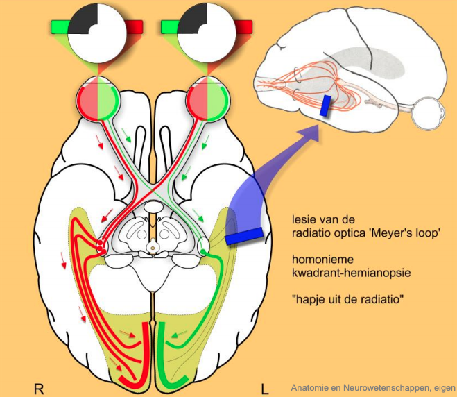 n. Opticus uitval 5