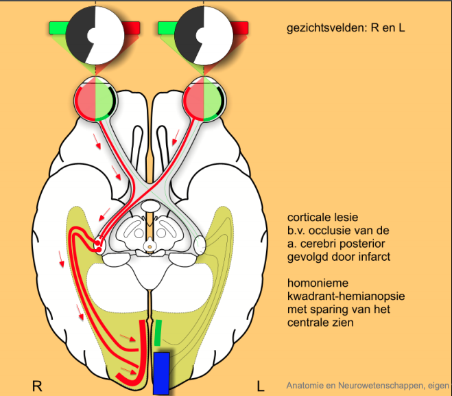 n. Opticus uitval 6