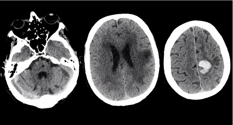 Hoe onderscheid je een herseninfarct of een hersenbloeding op een CT-scan? (Hypo-/Hyperdensiteit?)