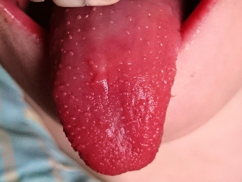 Wat is deze aandoening? Welke DD overweeg je? Geef een korte samenvatting.