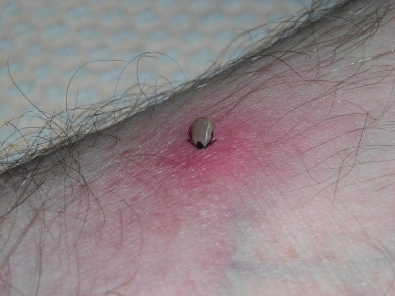 Wat is deze aandoening? Welke DD overweeg je? Geef een korte samenvatting.