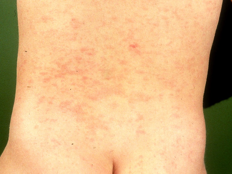 Wat is deze aandoening? Welke DD overweeg je? Geef een korte samenvatting.
