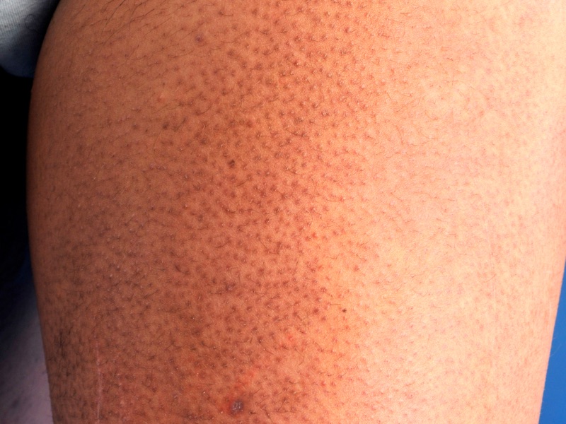 Wat is deze aandoening? Welke DD overweeg je? Geef een korte samenvatting.
