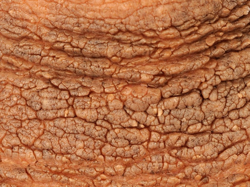 Wat is deze aandoening? Welke DD overweeg je? Geef een korte samenvatting.