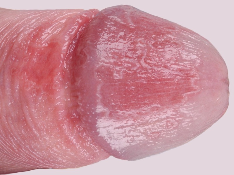 Wat is deze aandoening? Welke DD overweeg je? Geef een korte samenvatting.