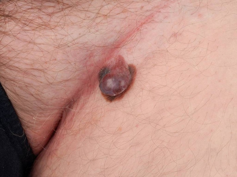 Wat is deze aandoening? Welke DD overweeg je? Geef een korte samenvatting.