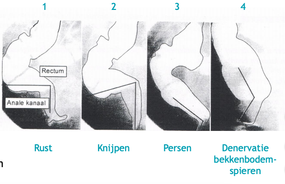Welke van deze geven incontinentie aan? College Muller 'SC Stofwisseling en Spijsverteringsprocessen'