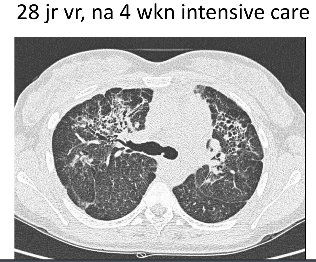 Wat zijn de drie radiologische kenmerken van longfibrose?