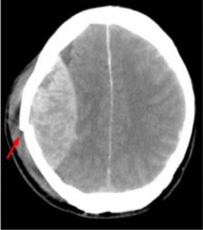 Welke afwijking zie je op de CT scan? Hoe ontstaat dit en welke symptomen gaan hiermee gepaard?