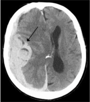 Welke afwijking zie je op de CT scan? Wat is typische ontstaanswijze en welke symptomen gaan hiermee gepaard?