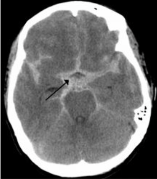 Welke afwijking zie je op de CT scan? Hoe ontstaat dit en welke symptomen gaan hiermee gepaard?
