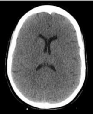 Welke afwijking zie je op de CT scan? Waardoor ontstaat dit beeld?