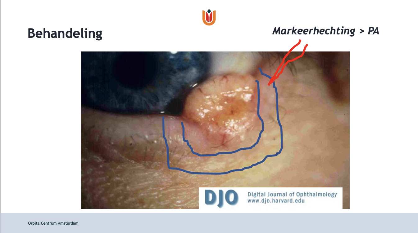 Wat zien we hier op de foto? Wat zijn risicofactoren voor deze aandoeningen en wat is de behandeling?