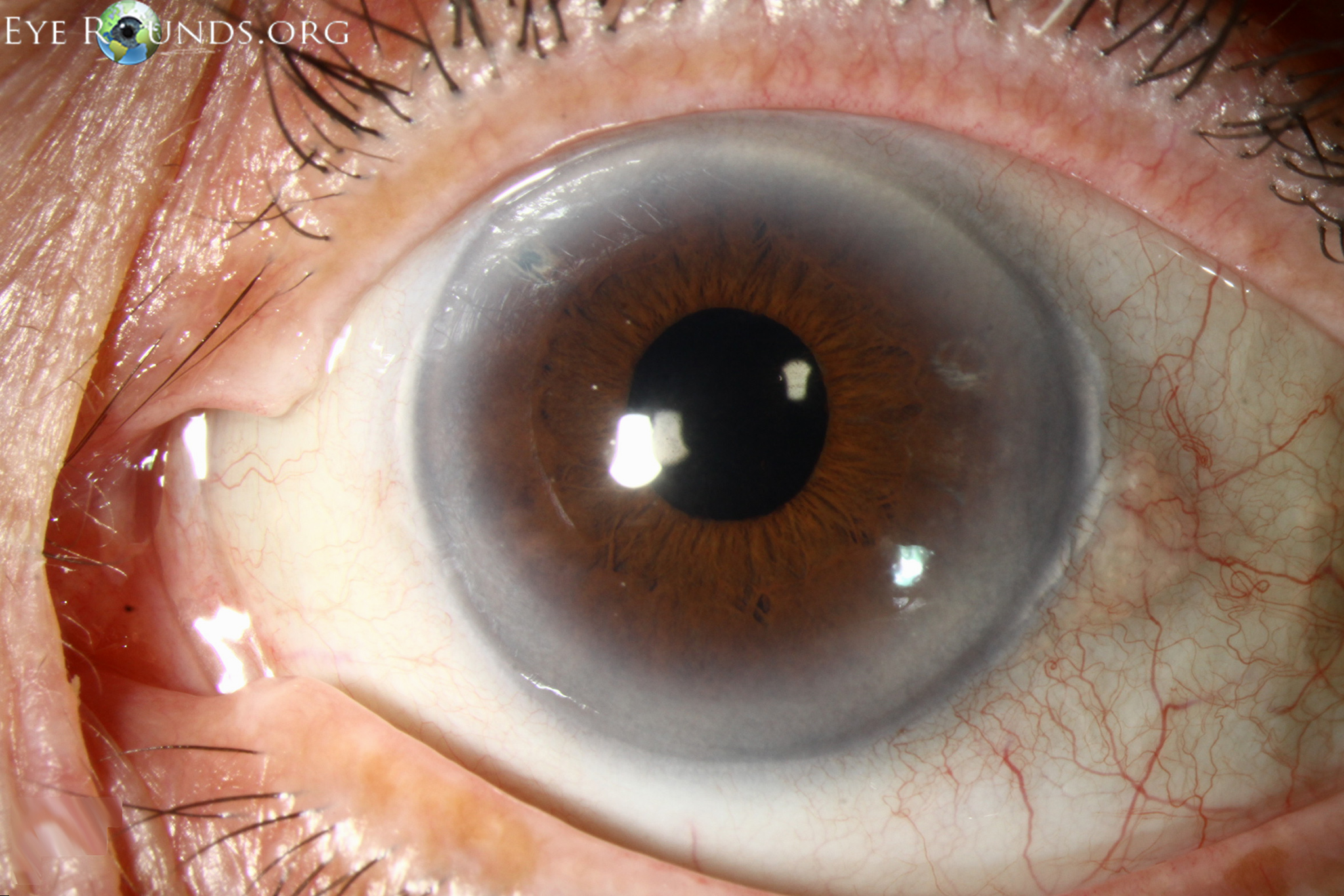Is dit eerste (arcus senilis) fysiologisch of pathogeen? Is dit tweede (arcus lipoides) fysiologisch of pathogeen?