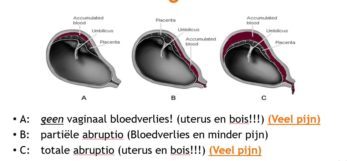 3 vormen van abruptio placenta; wat zijn de symptomen